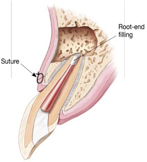 https://www.drmahabubsdentalcare.com/wp-content/uploads/2021/10/Apisectomy-2.jpg