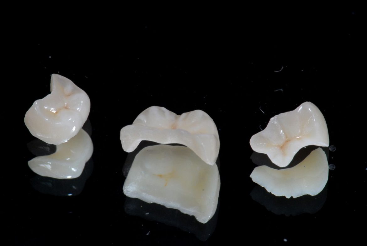 https://www.drmahabubsdentalcare.com/wp-content/uploads/2021/10/Ceramic_Inlay.jpg