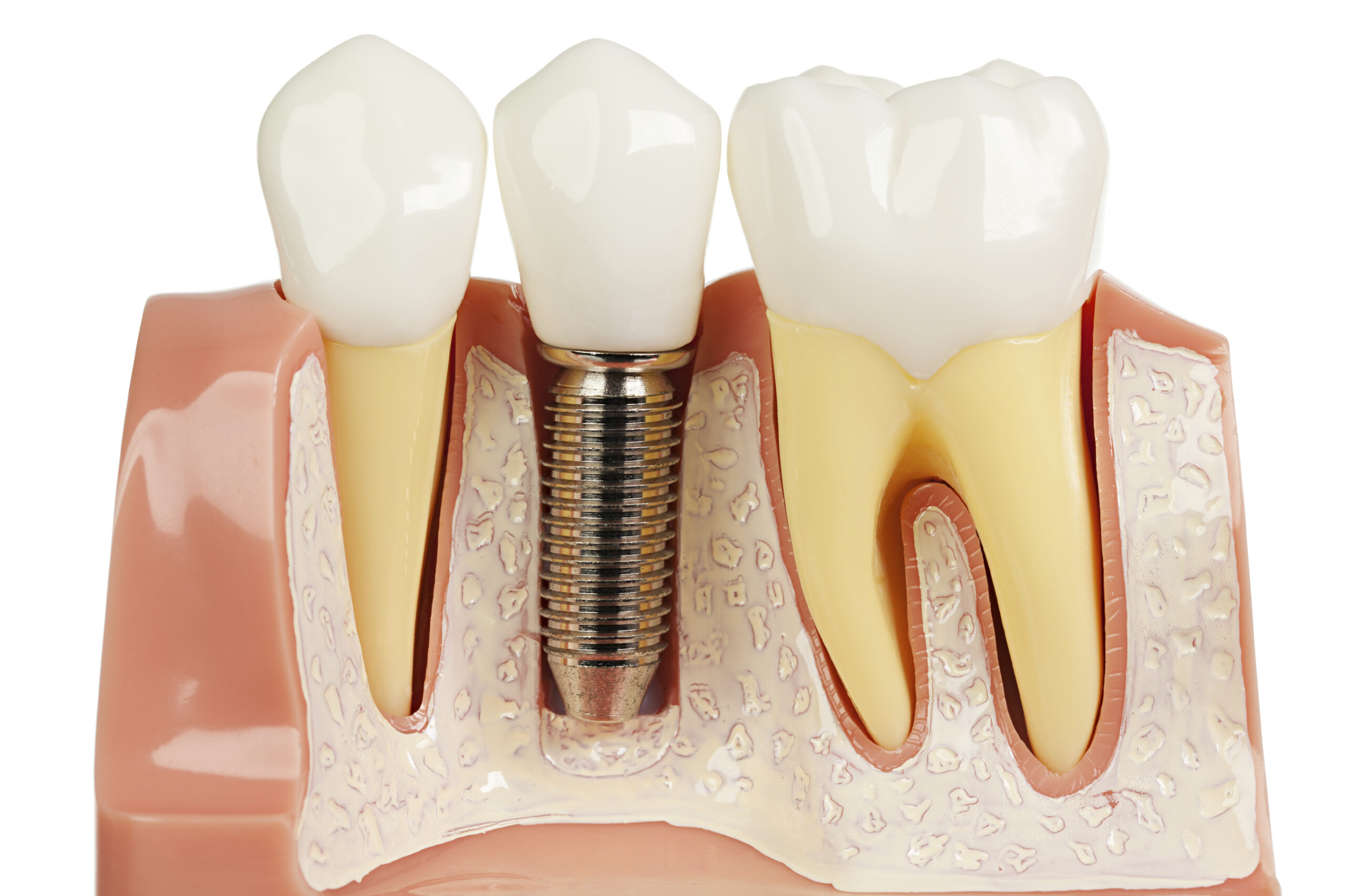 https://www.drmahabubsdentalcare.com/wp-content/uploads/2021/10/Dental_Implant-min-scaled.jpg
