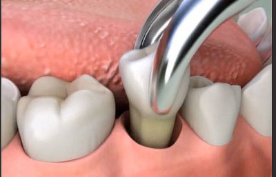 https://www.drmahabubsdentalcare.com/wp-content/uploads/2021/10/Extraction1.jpg