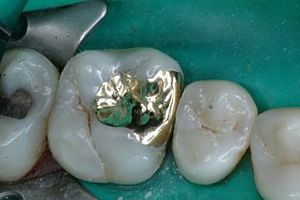 https://www.drmahabubsdentalcare.com/wp-content/uploads/2021/10/Metallic_Inlay.jpg