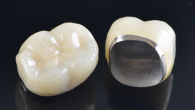 https://www.drmahabubsdentalcare.com/wp-content/uploads/2021/10/Porcelain_FM_Crown.jpg