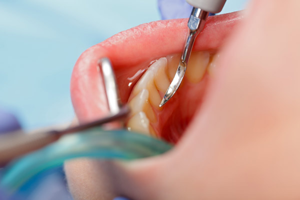 https://www.drmahabubsdentalcare.com/wp-content/uploads/2021/10/Scaling_Polishing.jpg